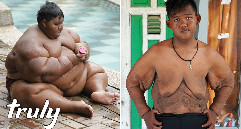 Criança “Mais Gorda Do Mundo” Perde Metade Do Peso e Está (Quase) Irreconhecível