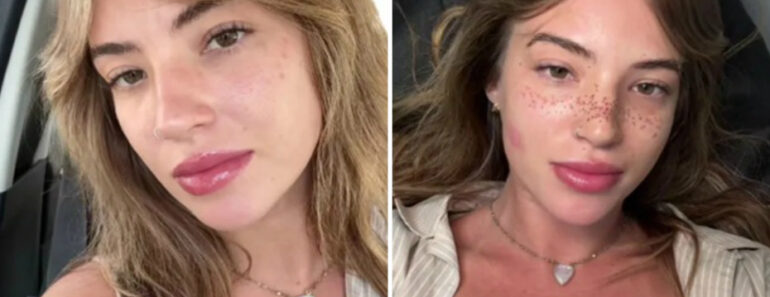 Farta De Maquilhar Sardas, Jovem Decide… Tatuá-las. Internet Não Gostou Farta De Maquilhar Sardas, Jovem Decide… Tatuá-las. Internet Não Gostou