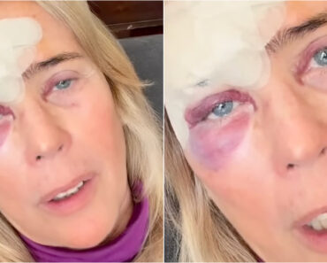 Felipa Garnel Deixa Alerta Sobre Exposição Solar Após Operação a Cancro De Pele Felipa Garnel Deixa Alerta Sobre Exposição Solar Após Operação a Cancro De Pele